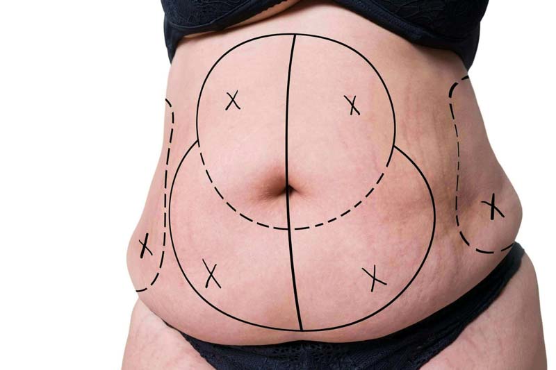 آماده سازی و انتخاب مناطق مناسب برای لیپوماتیک