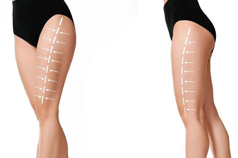 لیپوماتیک ران‌ پا